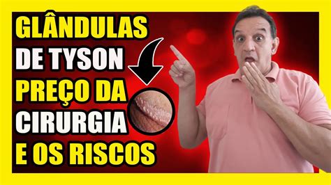 glandulas tyson o que é|Glândulas de Tyson: O que são e como tratar